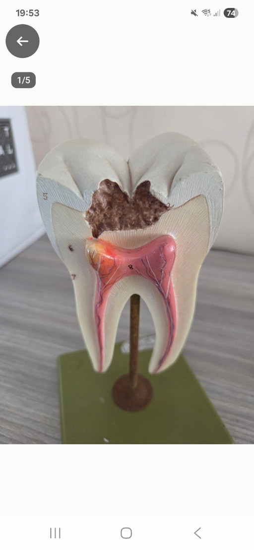 Educational Model Molar with Cavity, Vintage