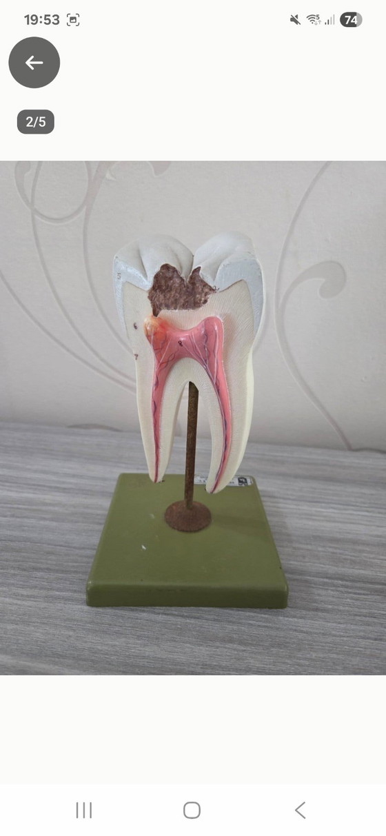 Educational Model Molar with Cavity, Vintage – Breukhoven B.V., Decorative Objects, Metal, Plastic (photo 2 of 5)